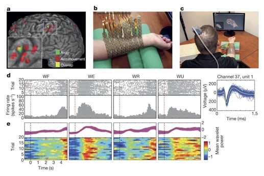 el cerrebro muestra la instalación y a la derecha el brazo con un modelo de los circuitos implantados